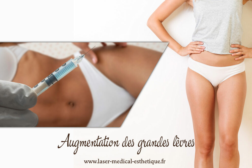 Augmentation des grandes lèvres