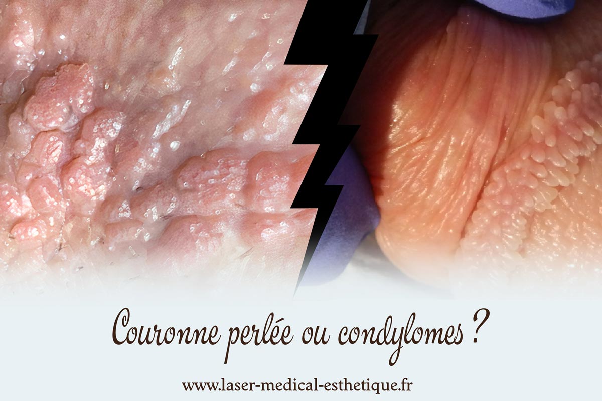 Couronne perlée ou condylomes