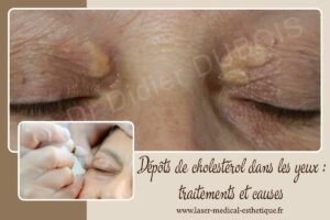 Dépôts de cholestérol dans les yeux