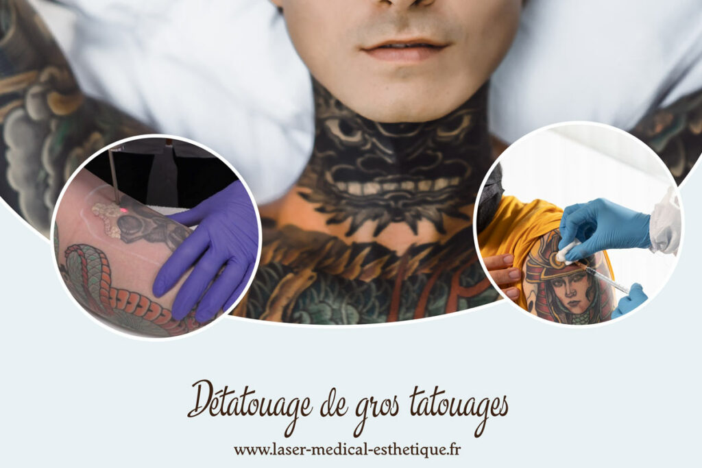 Détatouage de gros tatouages