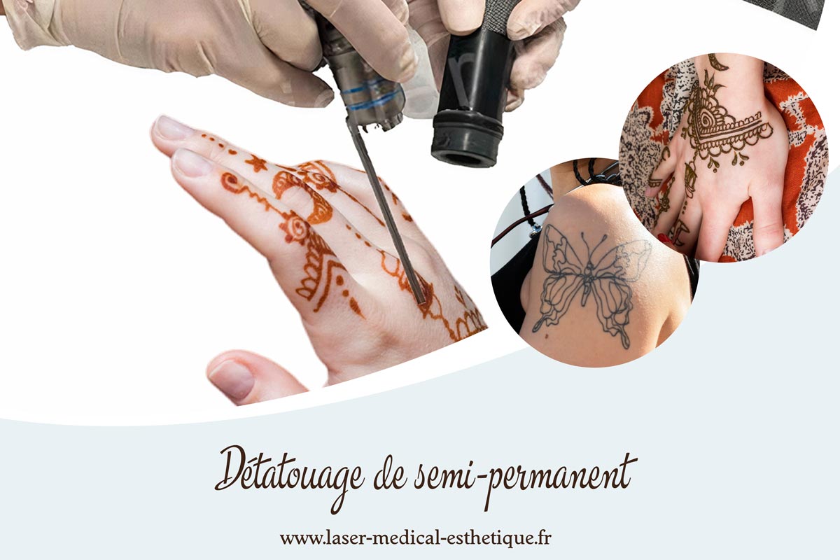 Détatouage de semi-permanent