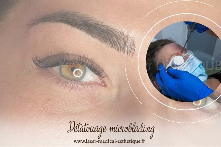 Détatouage microblading