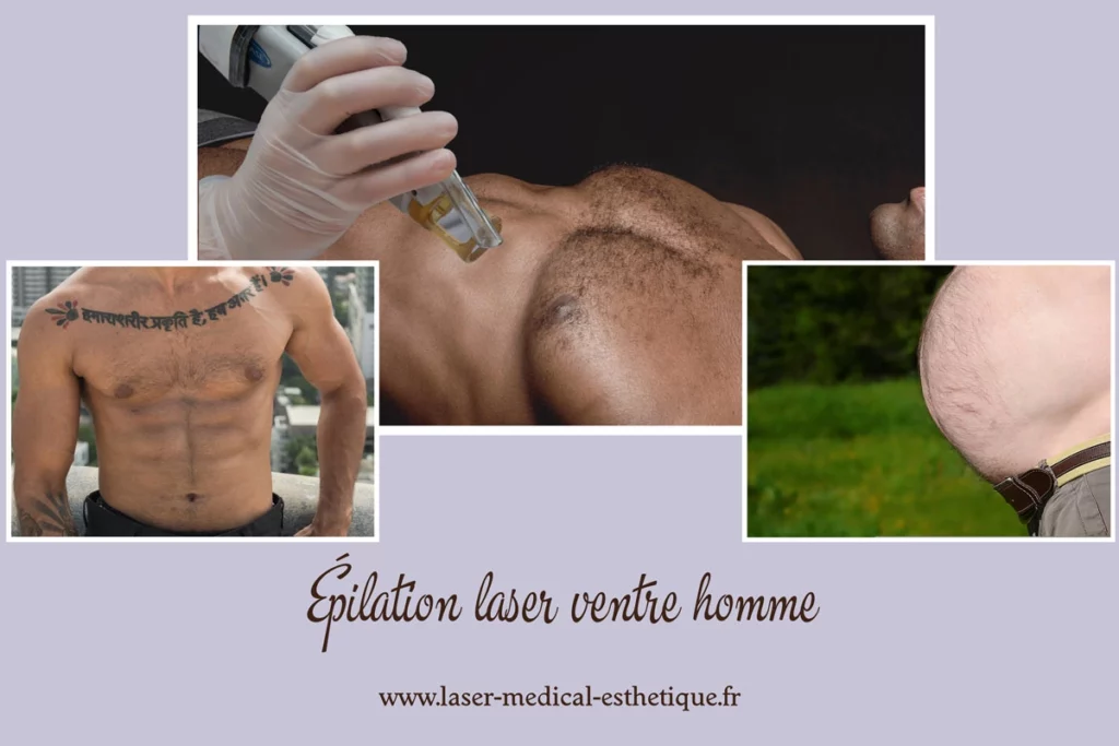 Epilation laser ventre homme