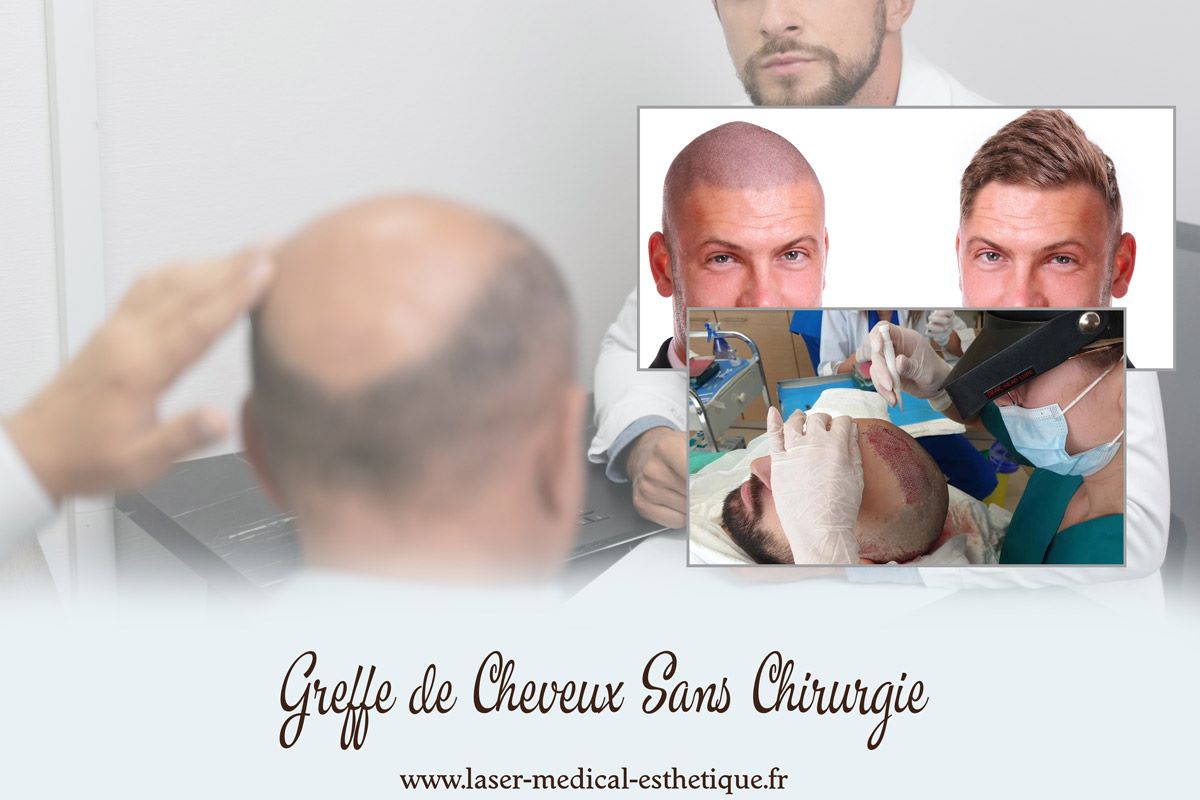 Greffe de Cheveux Sans Chirurgie