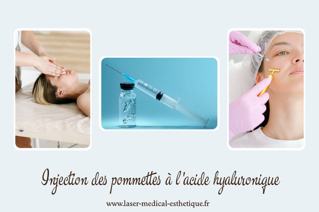 Injection d'acide hyaluronique dans les pommettes