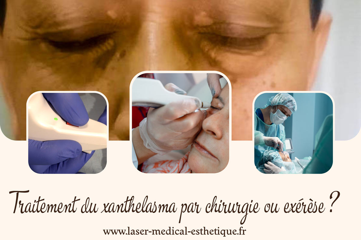 Traitement du xanthelasma par chirurgie ou exérèse