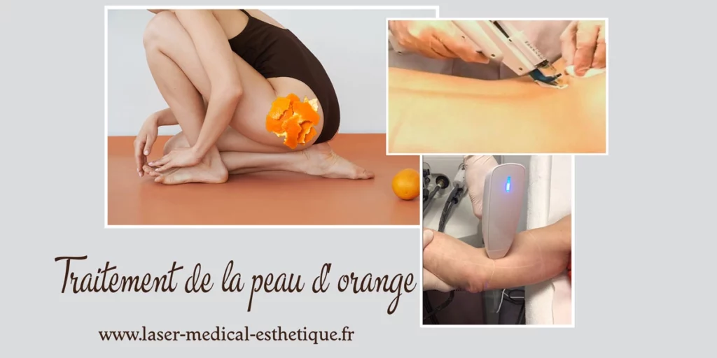 Traitement peau d'orange