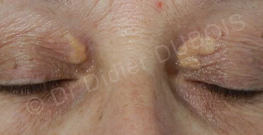 Xanthelasma