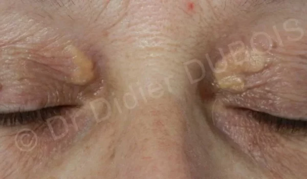 Xanthelasma