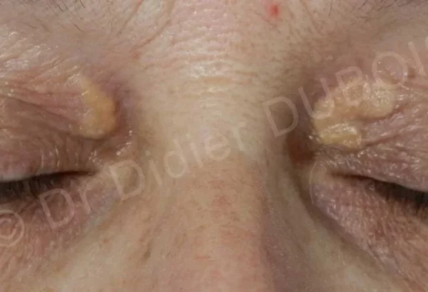 Xanthelasma