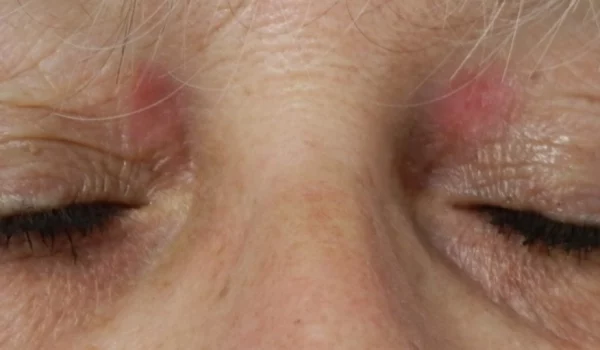 xanthelasma après