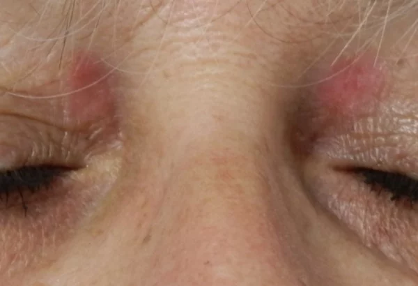 xanthelasma après