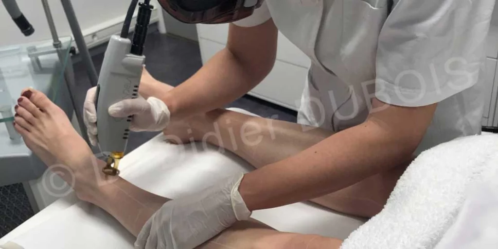 Epilation laser des jambes